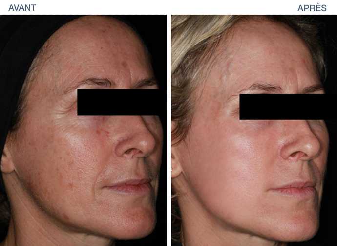 Treatment of wrinkles and sagging of the face