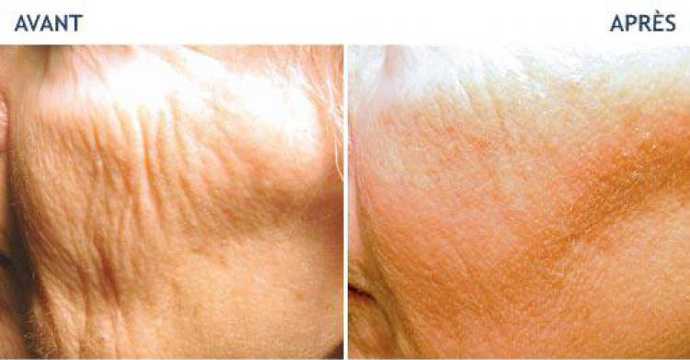 Before and after photos of a laser treatment of red spots