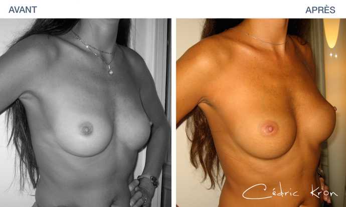 Before and after breast lipofilling