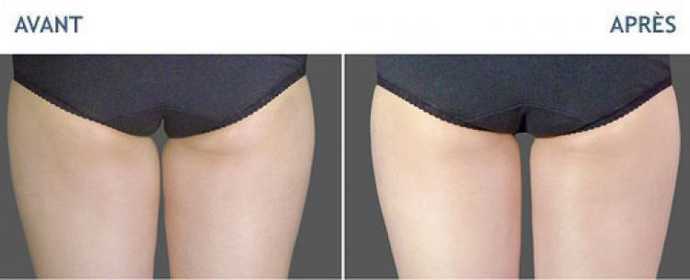 Before & After pictures of Cryolipolyse with Coolsculpting treatment