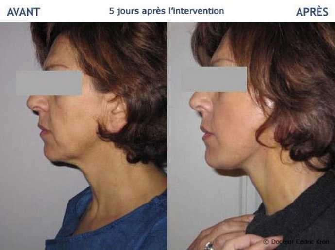 Avant - Après Lifting facial