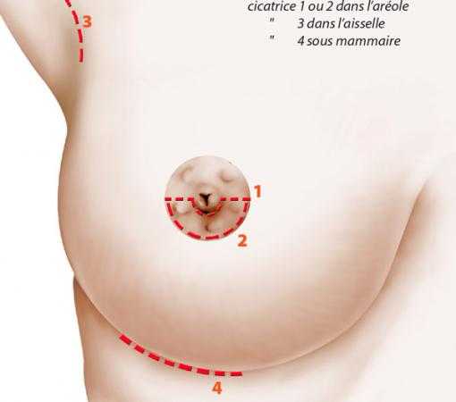 Position de la cicatrice en fonction du type d'incision pratiqué lors de la pose et le retrait de prothèses mammaires