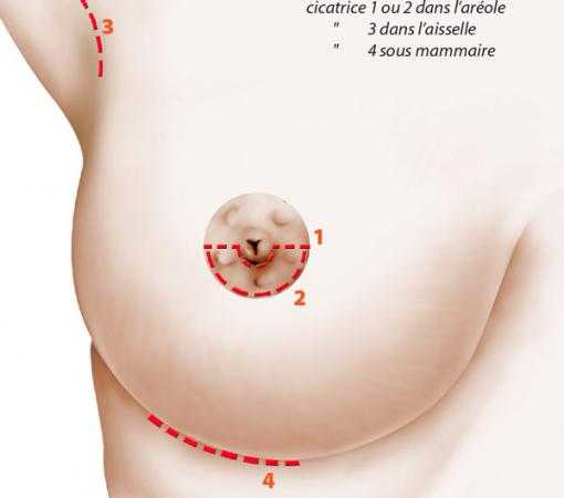 L’incision transaréolaire ou périaréolaire (1) ou sous-mamelonnaire (2)