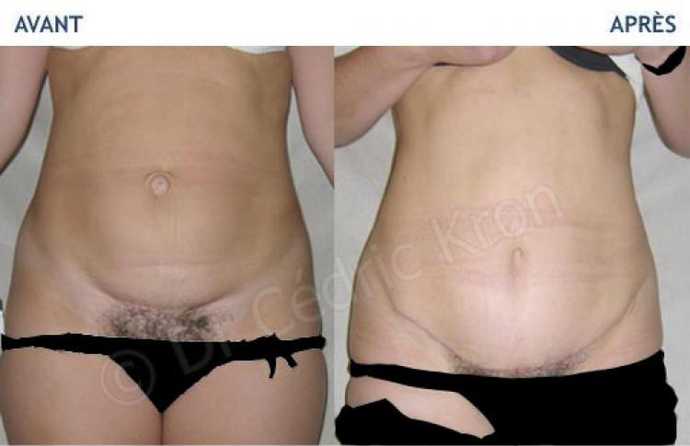 Before and after abdominoplasty