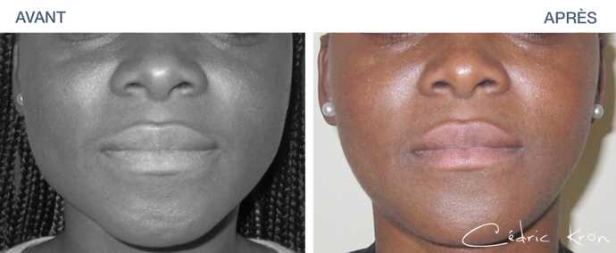 Avant - Après d'une réduction de la mâchoire par botox sur une femme