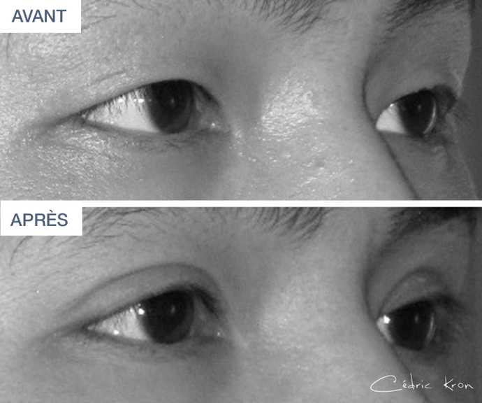 Avant - Après d'une blépharoplastie asiatique réalisée sur un homme (vue de côté)