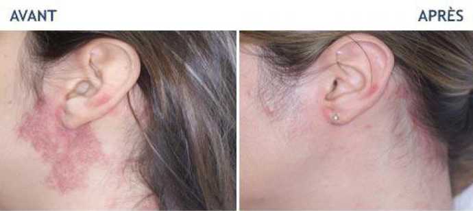 Before and after photos of a laser treatment of 