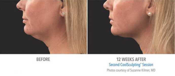 Before - After: removing double chin effect with Coolsculpting cryolipolysis technique