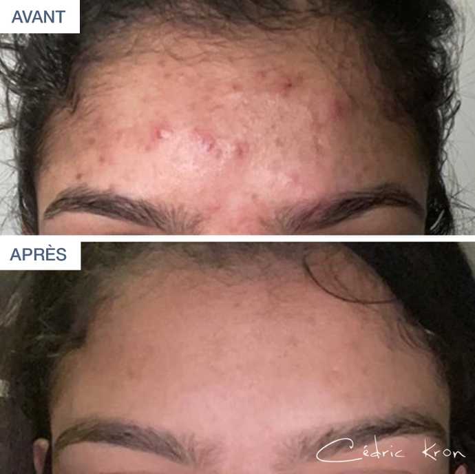 Avant - Après : Résultat HydraFacial sur l'acné