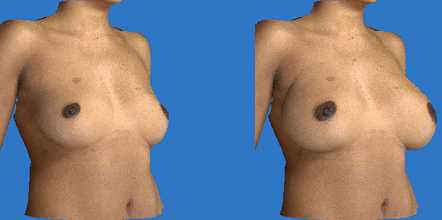 Simulation 3D d'augmentation mammaire