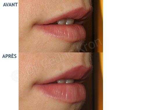 Traitement esthétique des lèvres : avant-après