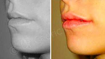 Before & After: Lip aesthetic treatment