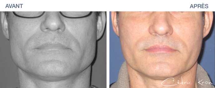 Avant - Après d'une réduction de la mâchoire par injection de botox sur un homme aux mâchoires carrées