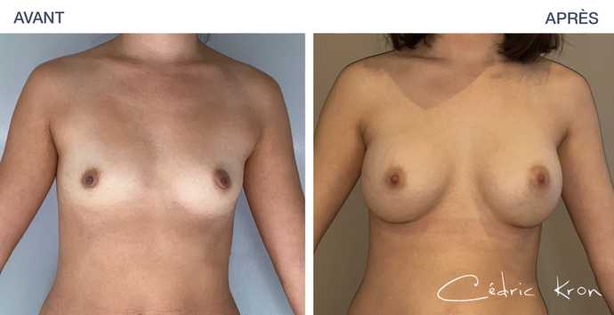 Augmentation mammaire par implants avant - après