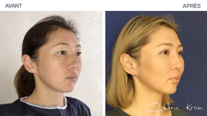 Before - After: results of rhinoplasty on Asian woman