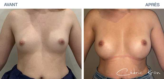Avant - Après : Augmentation mammaire avec des implants Ergonomix