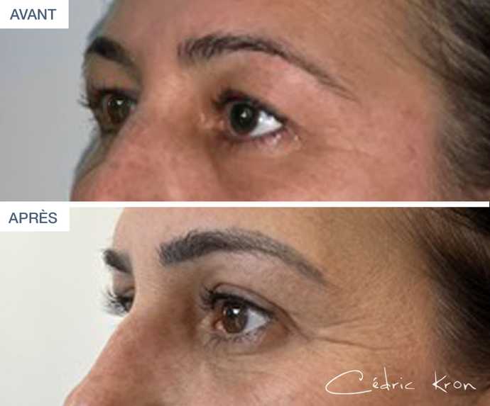 Avant-après - blépharoplastie des paupières sur une femme