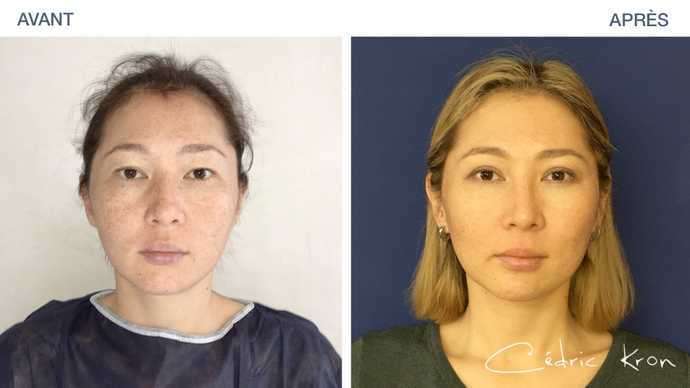 Before - After: results of rhinoplasty on Asian woman