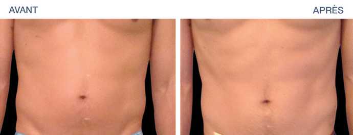 Before-After: Firming and toning of the Abdominal Belt
