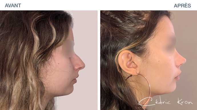 Avant - Après du résultat d'une rhinoplastie sur une jeune fille de 20 ans