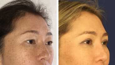 Before & After: Asian blepharoplasty - double eyelid surgery