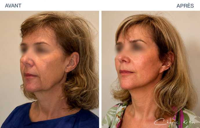 Avant - Après d'un lifting du visage LVPA sur une femme de 58 ans