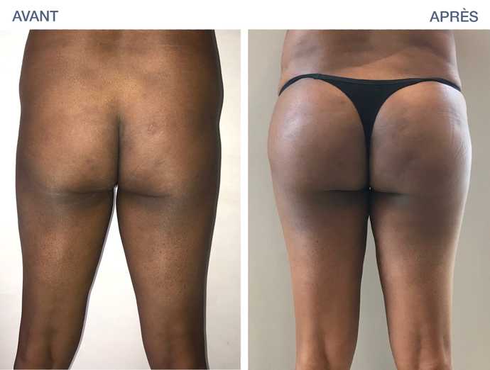 Before-after photo of a lipofilling of the buttocks