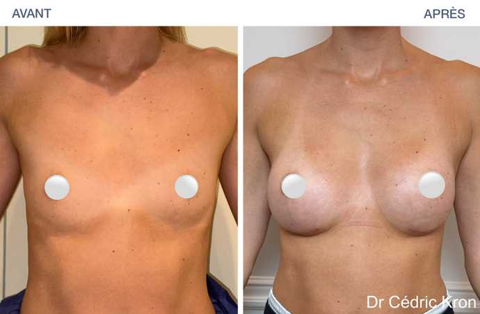 Augmentation mammaire avec implants Ergonomix2 (femme de 35 ans)
