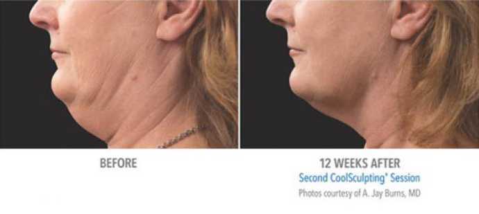 Before - After: removing double chin effect with Coolsculpting cryolipolysis technique