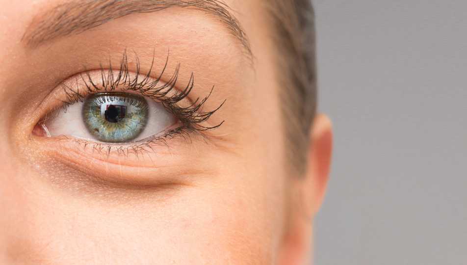 Blépharoplastie inférieure : Chirurgie des cernes pleins et des poches