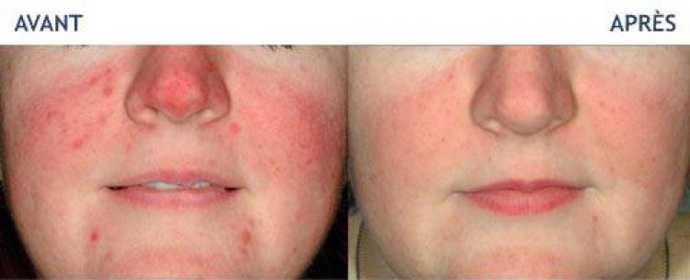 Avant - Après d'une correction de cicatrices d'acné par laser Icon : Résultat obtenu à la suite de 6 séances