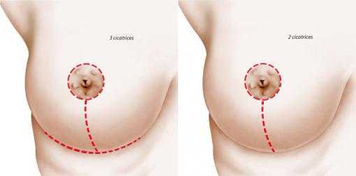 Position of scars induced by breast reduction surgery