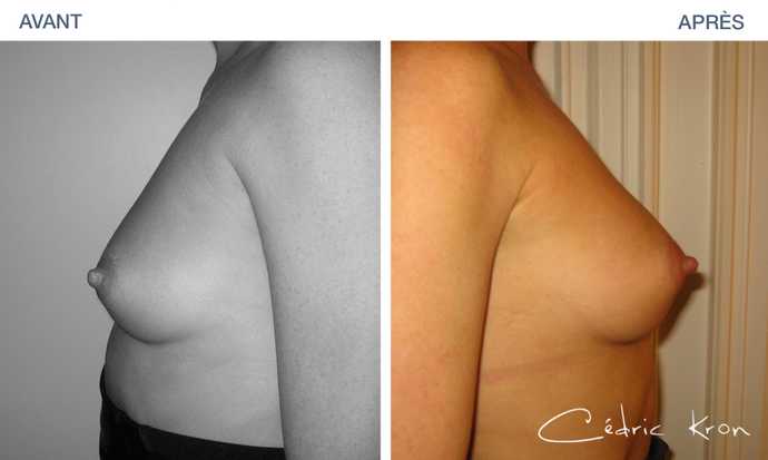 Before & after Breast lipofilling