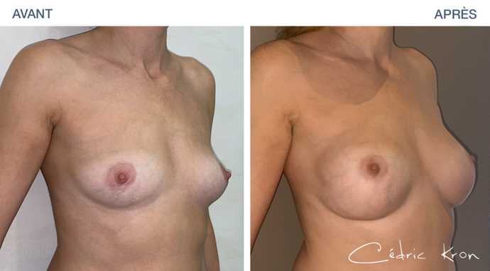 Avant-après : Augmentation mammaire avec correction d'une asymetrie