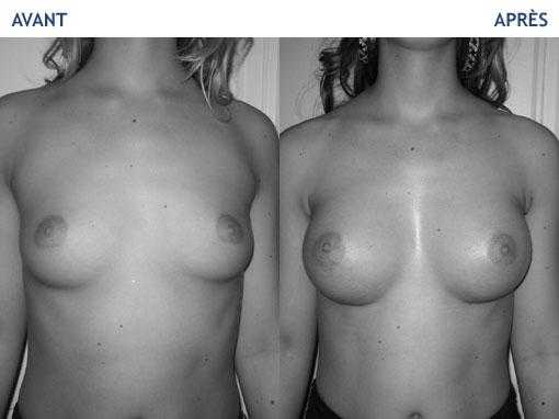 A natural breast conform to your desire