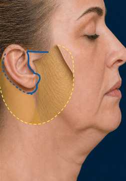 Diagram of an LVPA-type deep plane facelift: Skin undermining + SMAS exposure