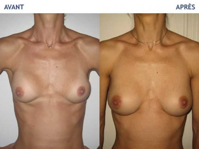 Before - After breast augmentation using implants