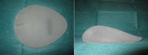 Anatomic breast implants