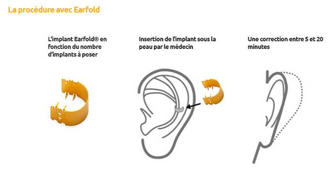 Correcteur esthétique pour oreilles de bébé, Correction