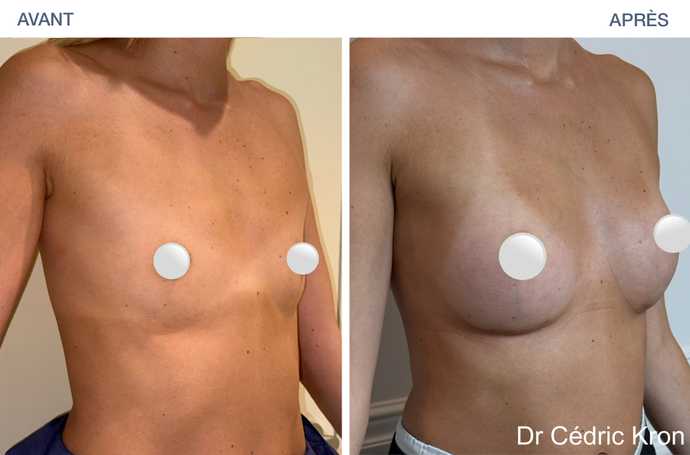 Avant - Après Augmentation mammaire avec implants Ergonomix2 (femme de 35 ans)