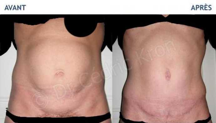Before and after pictures of abdominoplasty