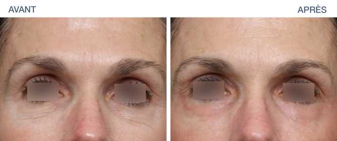 avant apres ultraclear 06