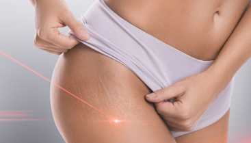 Laser Icon: Treatment of skin imperfections