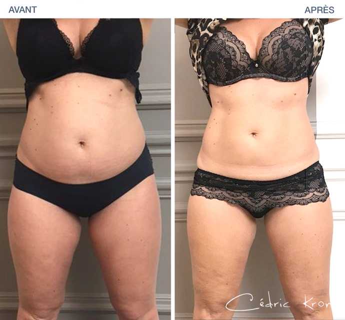 Résultat d'un amincissement du ventre par CoolSculpting en photo avant - après