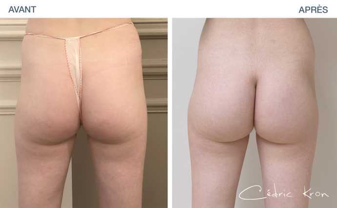 Avant-après : prothèses de fesses et traitement EMSculpt