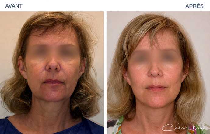 Before - After pictures : facelift LVPA on a 58-year-old woman