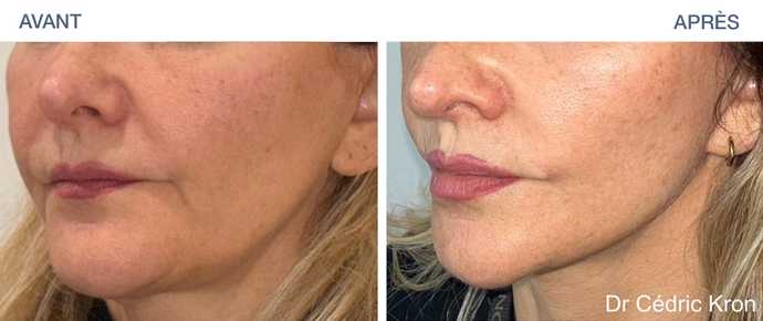 Avant - Après Lifting du visage à Paris