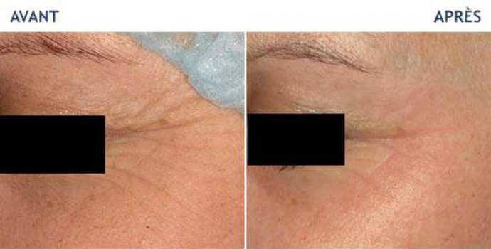 Before and after photos of a laser treatment of 