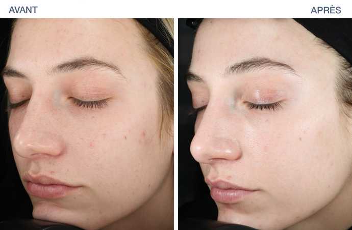 avant apres ultraclear 02