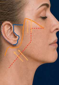 Diagram of an LVPA-type deep plane facelift: Posterior repositioning + SMAS fixation
